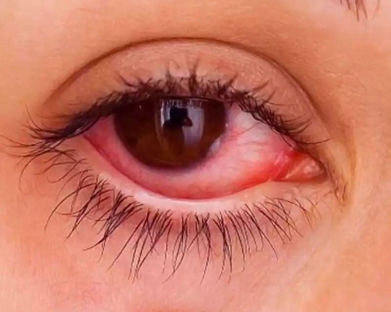 eyelash glue burning eyes