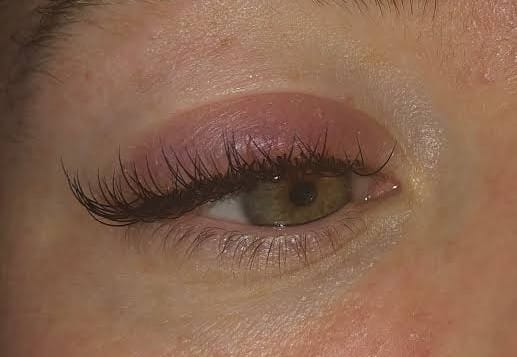 Allergic Reactions eyes