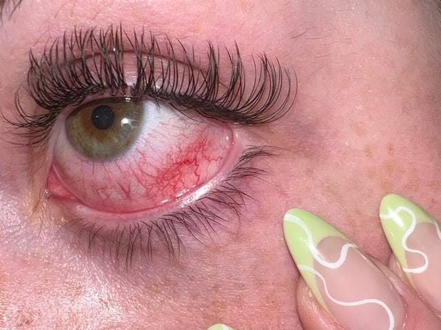 Red or Bloodshot Eyes
